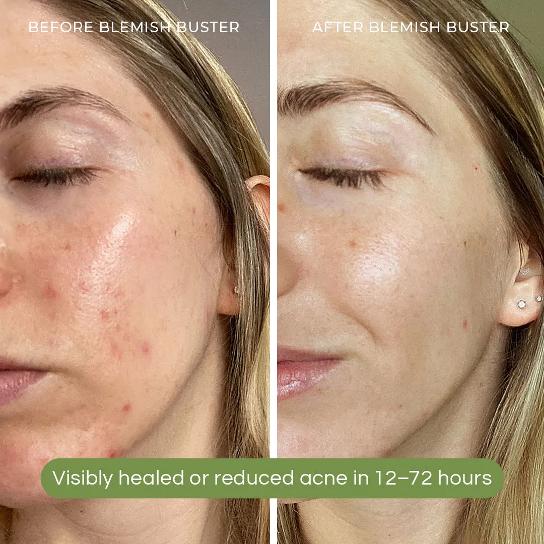 Blemish Buster