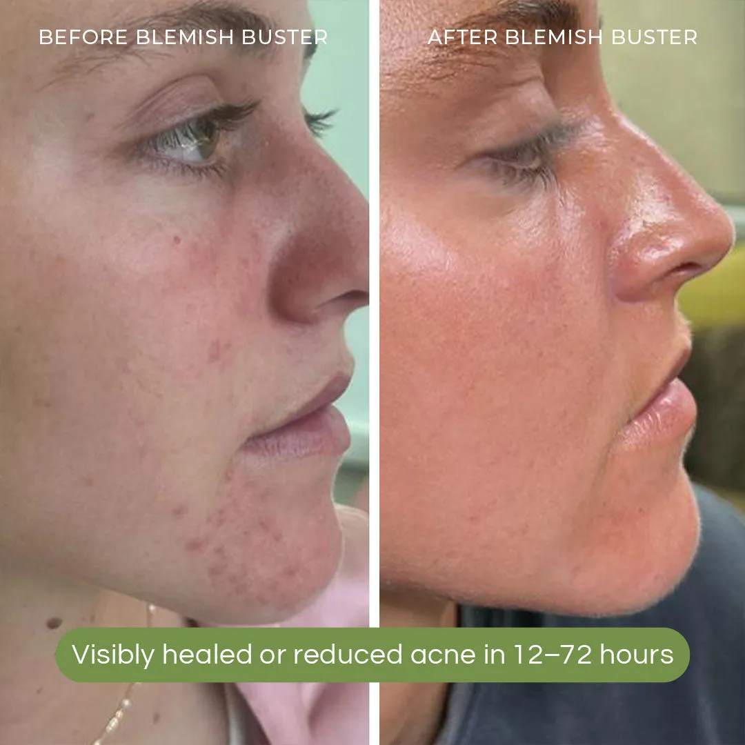 Blemish Buster